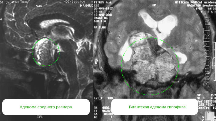 Макроаденома гипофиза