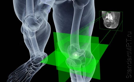 МРТ коленного сустава в Спб